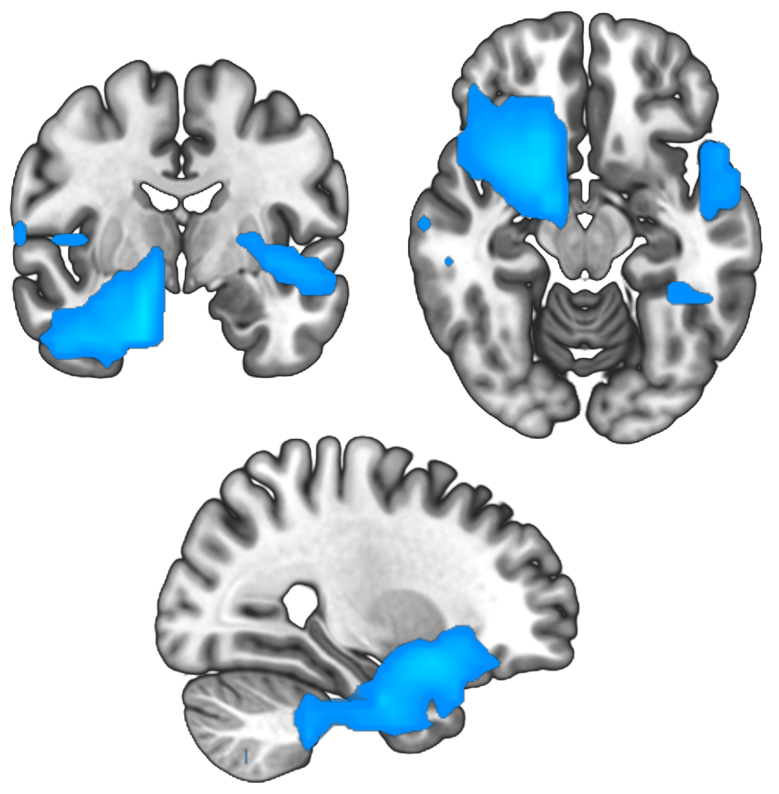 Results from an MEG study, showing activity in the medial temporal lobe